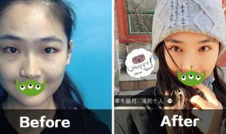 韩式三点定位双眼皮价格 三点定位双眼皮什么时候恢复自然